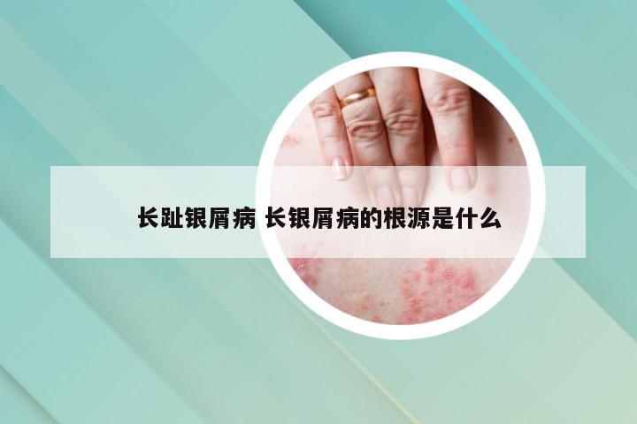 长趾银屑病 长银屑病的根源是什么