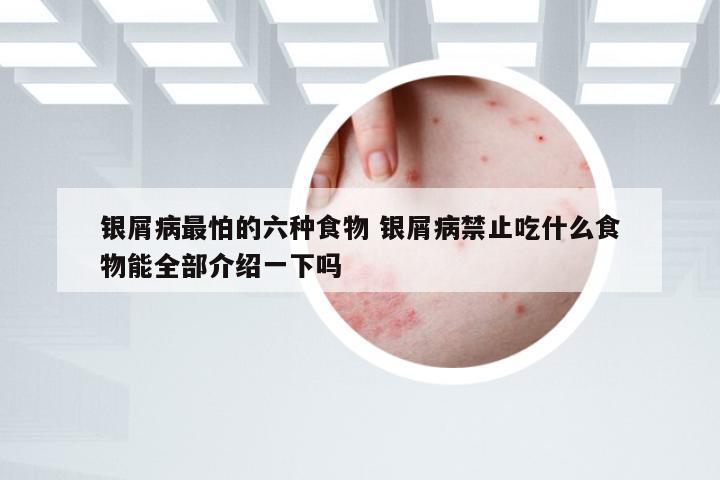 银屑病最怕的六种食物 银屑病禁止吃什么食物能全部介绍一下吗