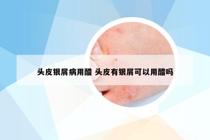 头皮银屑病用醋 头皮有银屑可以用醋吗