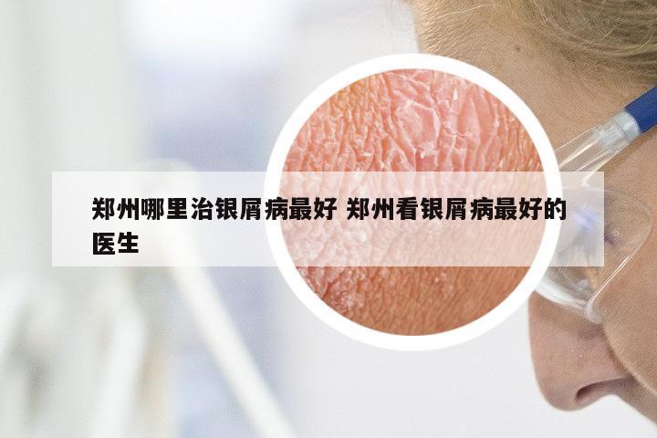 郑州哪里治银屑病最好 郑州看银屑病最好的医生