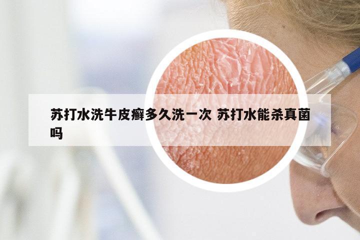 苏打水洗牛皮癣多久洗一次 苏打水能杀真菌吗