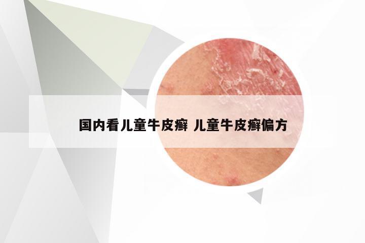 国内看儿童牛皮癣 儿童牛皮癣偏方