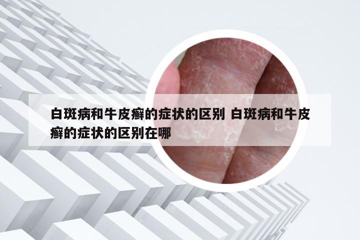 白斑病和牛皮癣的症状的区别 白斑病和牛皮癣的症状的区别在哪