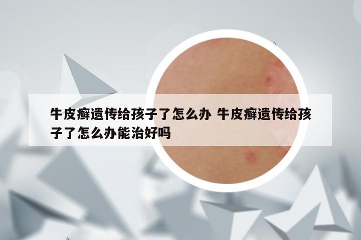 牛皮癣遗传给孩子了怎么办 牛皮癣遗传给孩子了怎么办能治好吗