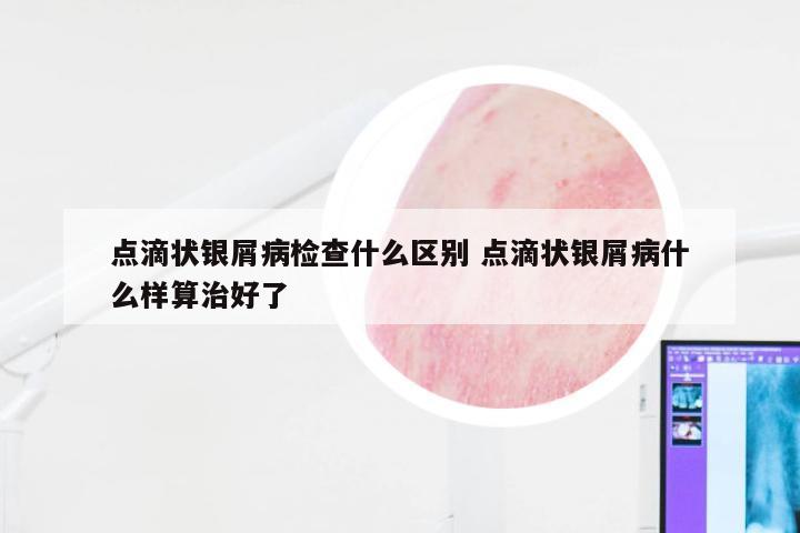 点滴状银屑病检查什么区别 点滴状银屑病什么样算治好了