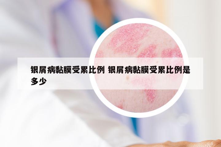 银屑病黏膜受累比例 银屑病黏膜受累比例是多少