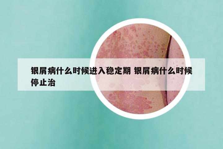 银屑病什么时候进入稳定期 银屑病什么时候停止治