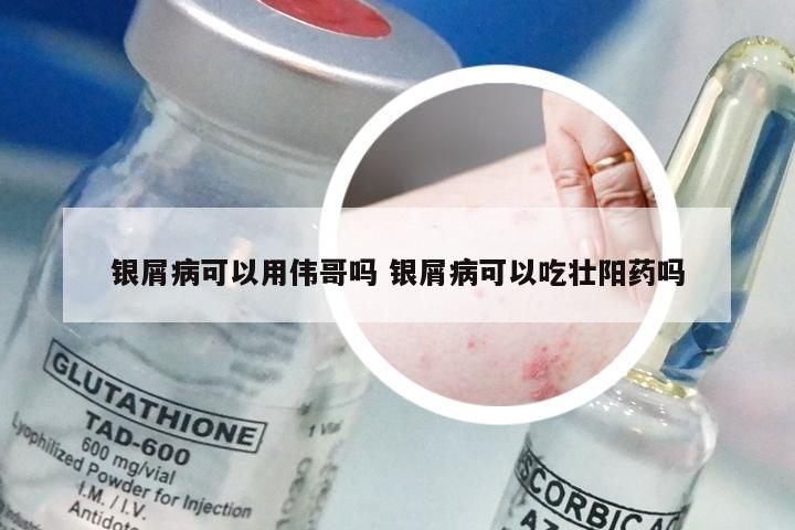 银屑病可以用伟哥吗 银屑病可以吃壮阳药吗