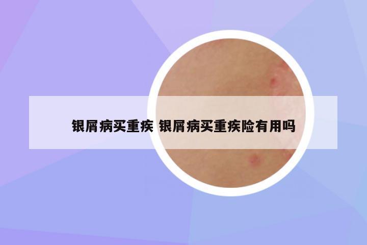 银屑病买重疾 银屑病买重疾险有用吗