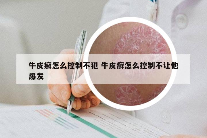 牛皮癣怎么控制不犯 牛皮癣怎么控制不让他爆发