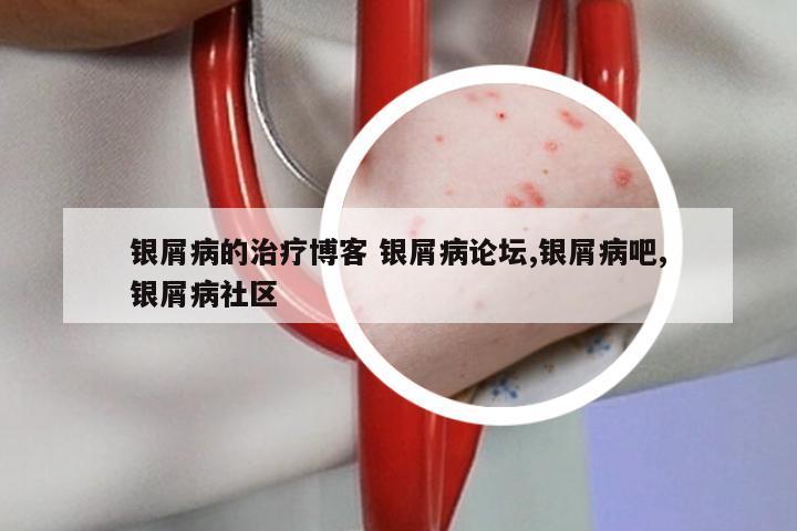 银屑病的治疗博客 银屑病论坛,银屑病吧,银屑病社区