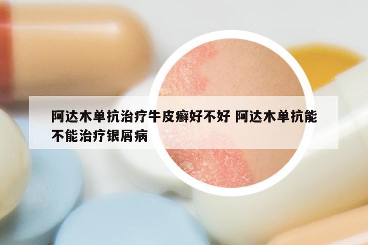 阿达木单抗治疗牛皮癣好不好 阿达木单抗能不能治疗银屑病