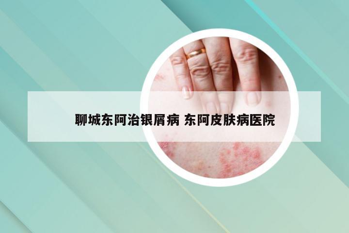 聊城东阿治银屑病 东阿皮肤病医院