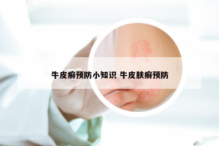牛皮癣预防小知识 牛皮肤癣预防