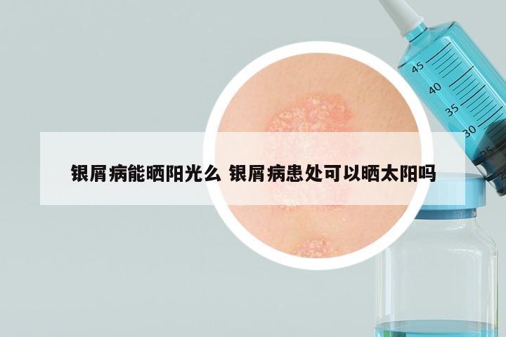银屑病能晒阳光么 银屑病患处可以晒太阳吗