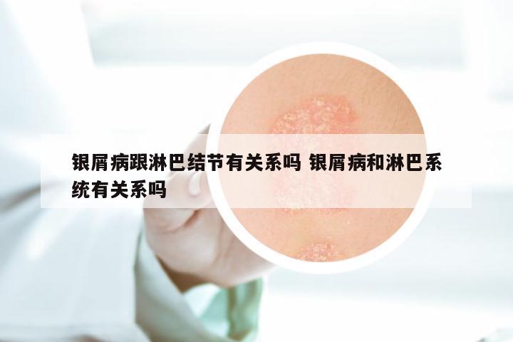 银屑病跟淋巴结节有关系吗 银屑病和淋巴系统有关系吗