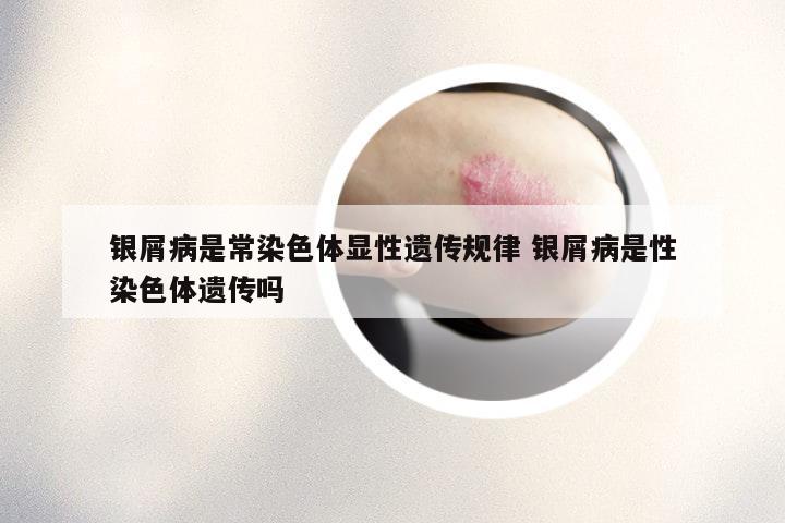 银屑病是常染色体显性遗传规律 银屑病是性染色体遗传吗
