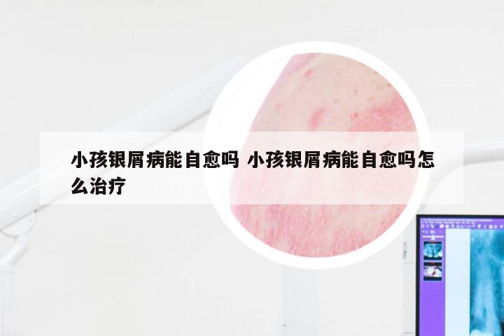 小孩银屑病能自愈吗 小孩银屑病能自愈吗怎么治疗