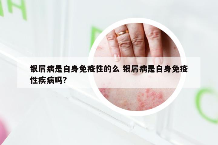 银屑病是自身免疫性的么 银屑病是自身免疫性疾病吗?