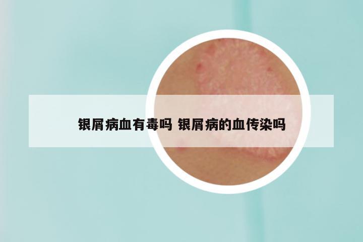 银屑病血有毒吗 银屑病的血传染吗