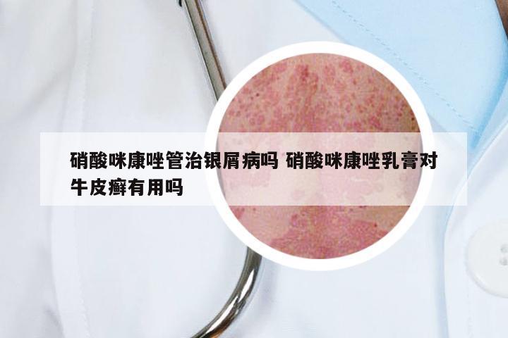 硝酸咪康唑管治银屑病吗 硝酸咪康唑乳膏对牛皮癣有用吗
