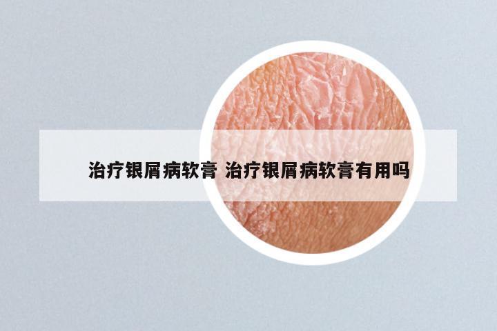 治疗银屑病软膏 治疗银屑病软膏有用吗