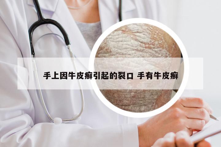 手上因牛皮癣引起的裂口 手有牛皮癣