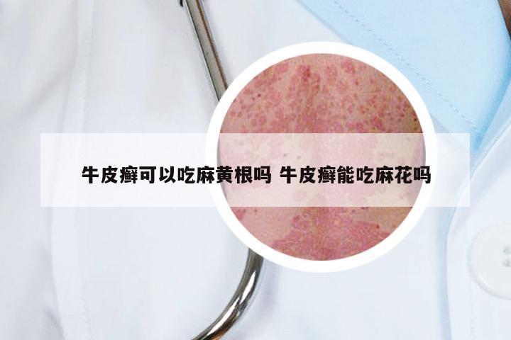牛皮癣可以吃麻黄根吗 牛皮癣能吃麻花吗