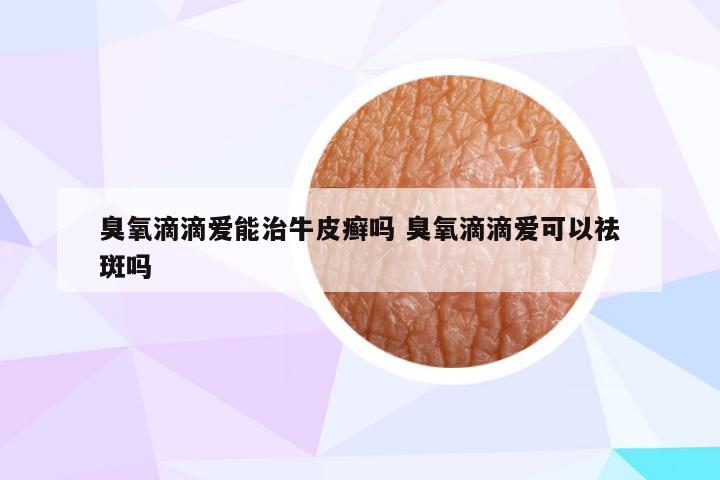 臭氧滴滴爱能治牛皮癣吗 臭氧滴滴爱可以祛斑吗