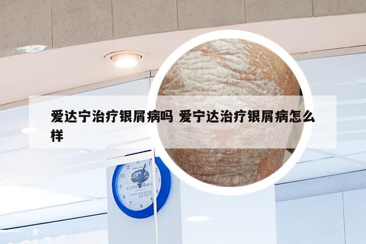 爱达宁治疗银屑病吗 爱宁达治疗银屑病怎么样