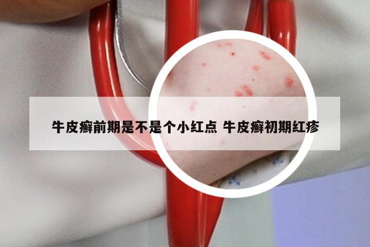 牛皮癣前期是不是个小红点 牛皮癣初期红疹