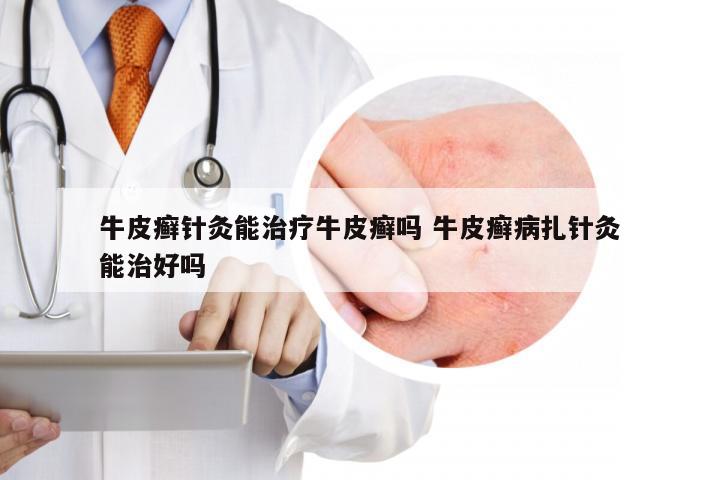 牛皮癣针灸能治疗牛皮癣吗 牛皮癣病扎针灸能治好吗