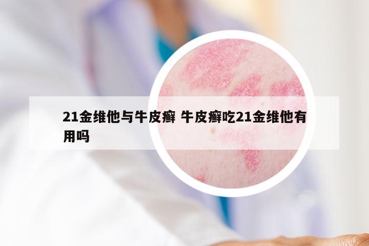 21金维他与牛皮癣 牛皮癣吃21金维他有用吗
