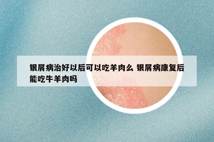 银屑病治好以后可以吃羊肉么 银屑病康复后能吃牛羊肉吗