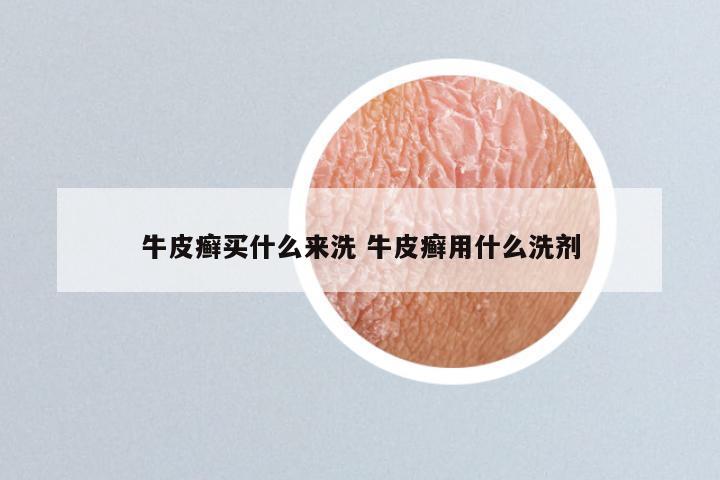 牛皮癣买什么来洗 牛皮癣用什么洗剂