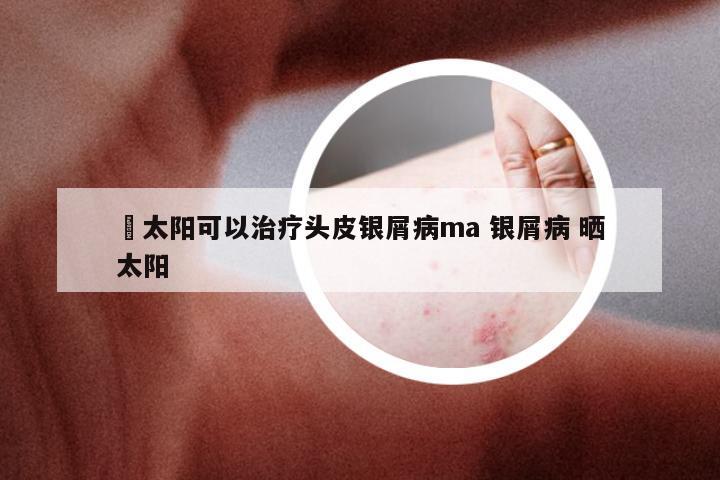 嗮太阳可以治疗头皮银屑病ma 银屑病 晒太阳