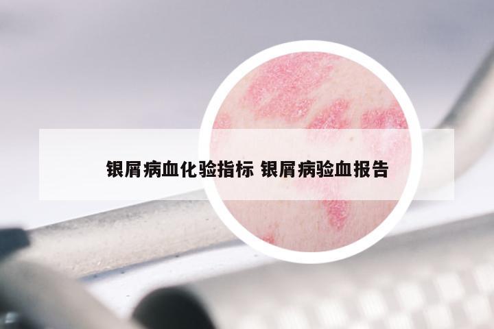 银屑病血化验指标 银屑病验血报告