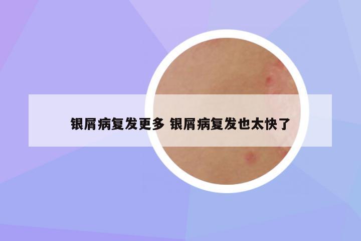 银屑病复发更多 银屑病复发也太快了
