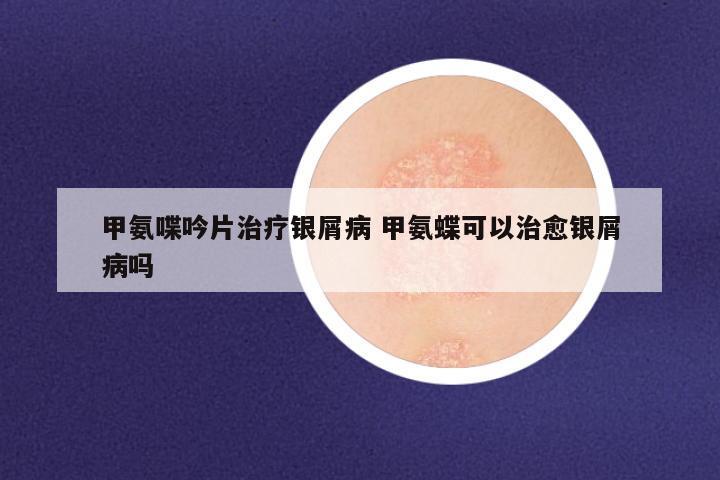 甲氨喋吟片治疗银屑病 甲氨蝶可以治愈银屑病吗