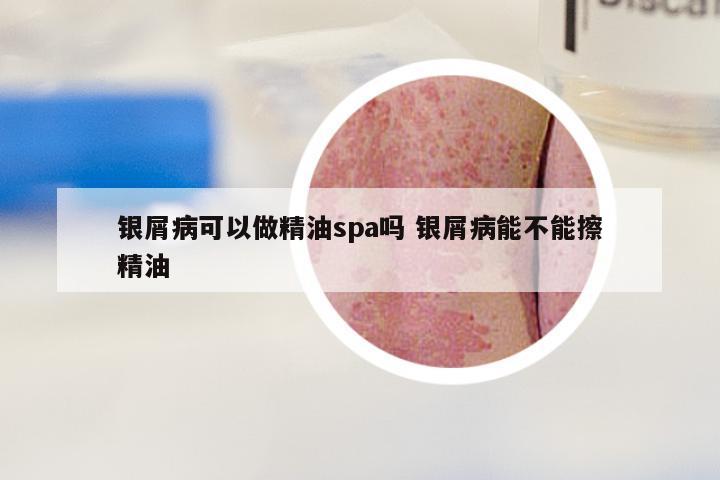 银屑病可以做精油spa吗 银屑病能不能擦精油