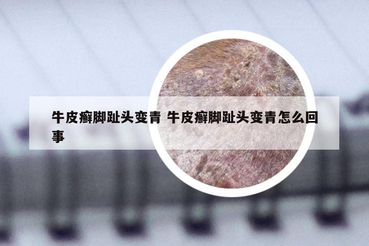 牛皮癣脚趾头变青 牛皮癣脚趾头变青怎么回事