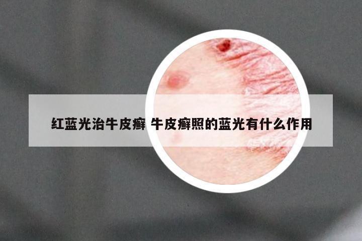 红蓝光治牛皮癣 牛皮癣照的蓝光有什么作用
