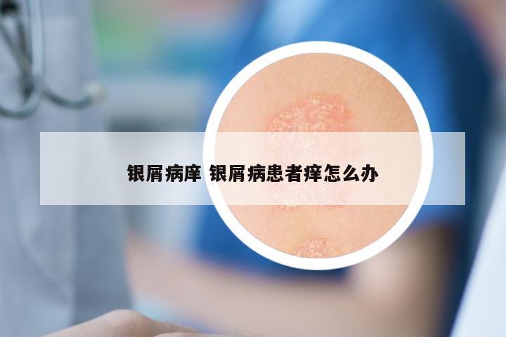 银屑病庠 银屑病患者痒怎么办