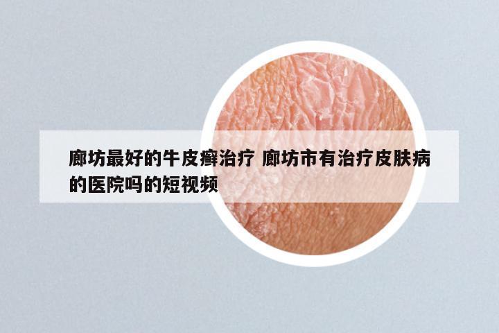 廊坊最好的牛皮癣治疗 廊坊市有治疗皮肤病的医院吗的短视频