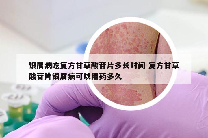 银屑病吃复方甘草酸苷片多长时间 复方甘草酸苷片银屑病可以用药多久