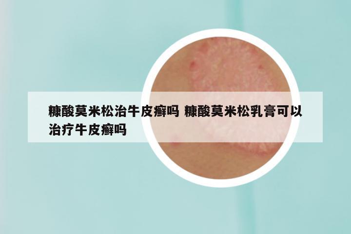 糠酸莫米松治牛皮癣吗 糠酸莫米松乳膏可以治疗牛皮癣吗