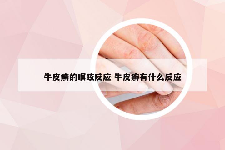 牛皮癣的瞑眩反应 牛皮癣有什么反应