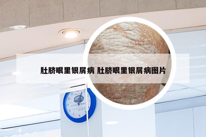 肚脐眼里银屑病 肚脐眼里银屑病图片