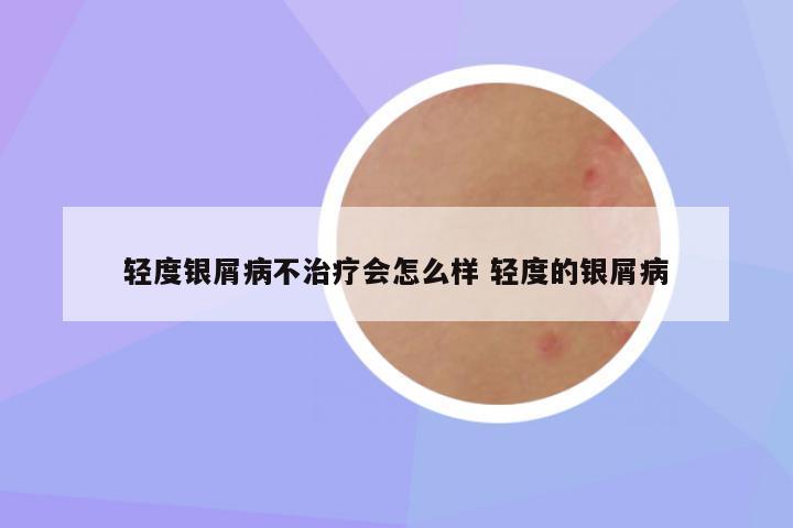 轻度银屑病不治疗会怎么样 轻度的银屑病