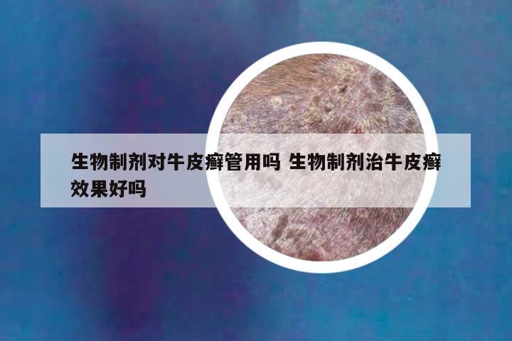 生物制剂对牛皮癣管用吗 生物制剂治牛皮癣效果好吗